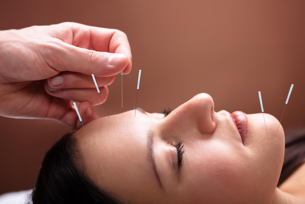 Advanced Acupuncture Focuses on Personalized Healing for the Miami Beach Community