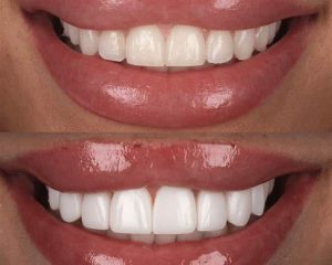 ¿Cómo se Realiza un Tratamiento de Implantes Dentales Toda la Boca?v