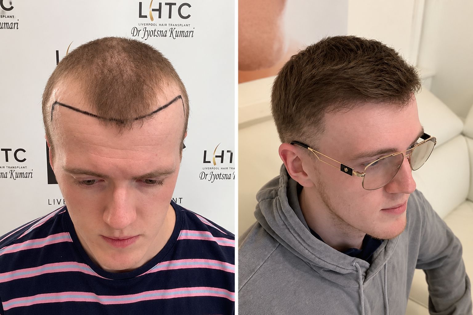 FUE hair transplant Before and After