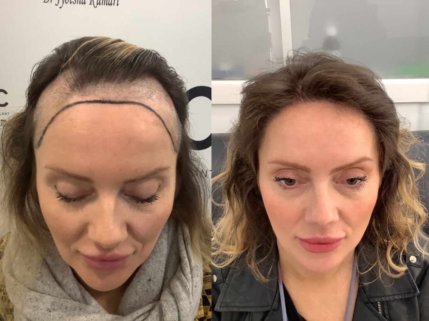Rising demand for hair transplants in the Merseyside region