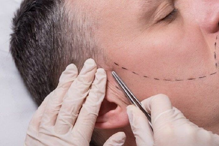 Beard Transplant UK