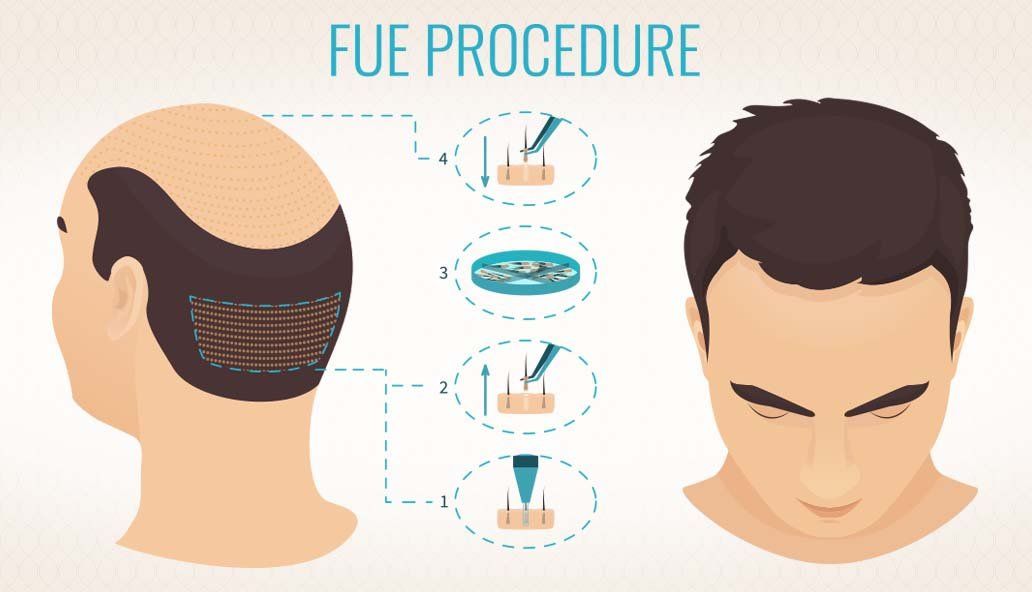Want Hair Ltd Welcomes New Specialist Team to Lead FUE Hair Replacement Treatments